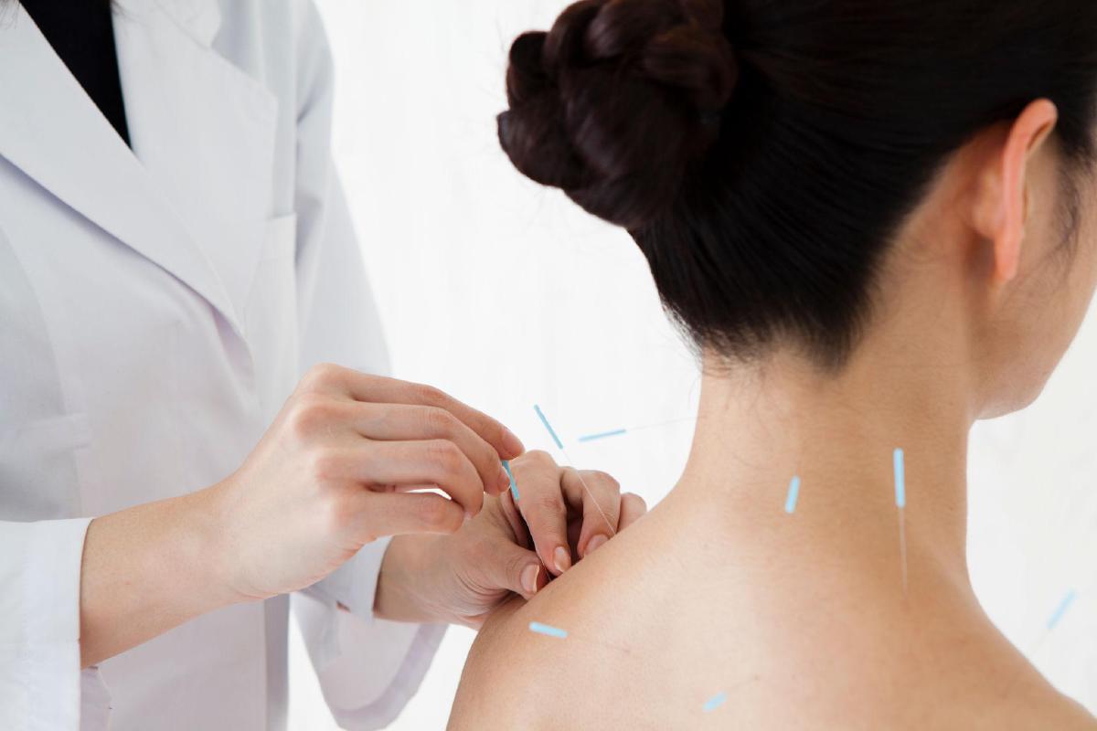 Benefits of Acupuncture